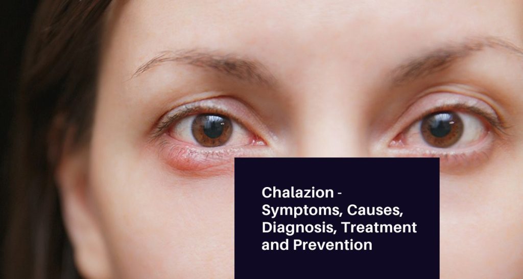 Chalazion - Symptoms, Causes, Diagnosis, Treatment and Prevention