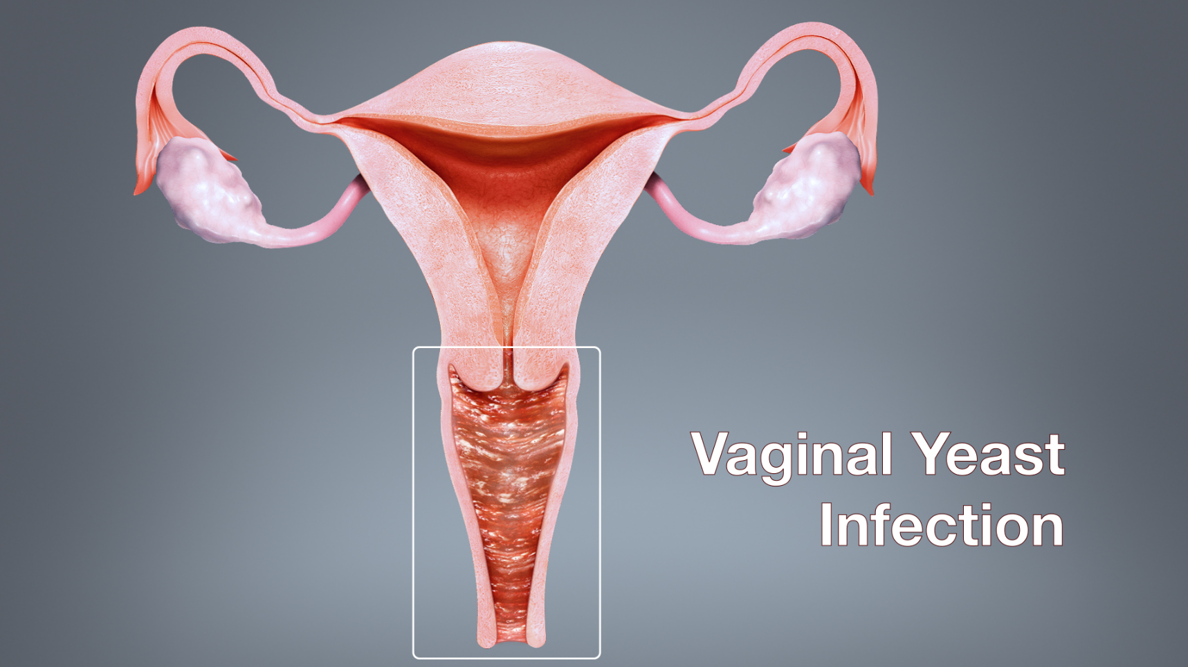 Yeast Infection