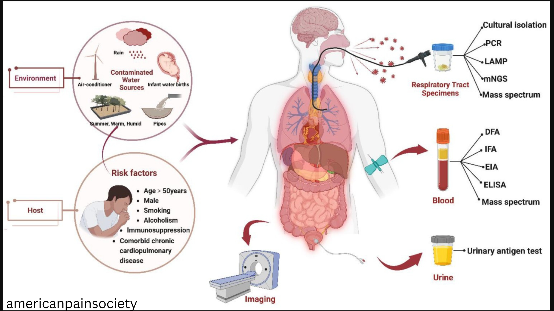 Legionnaires' Causes, Symptoms