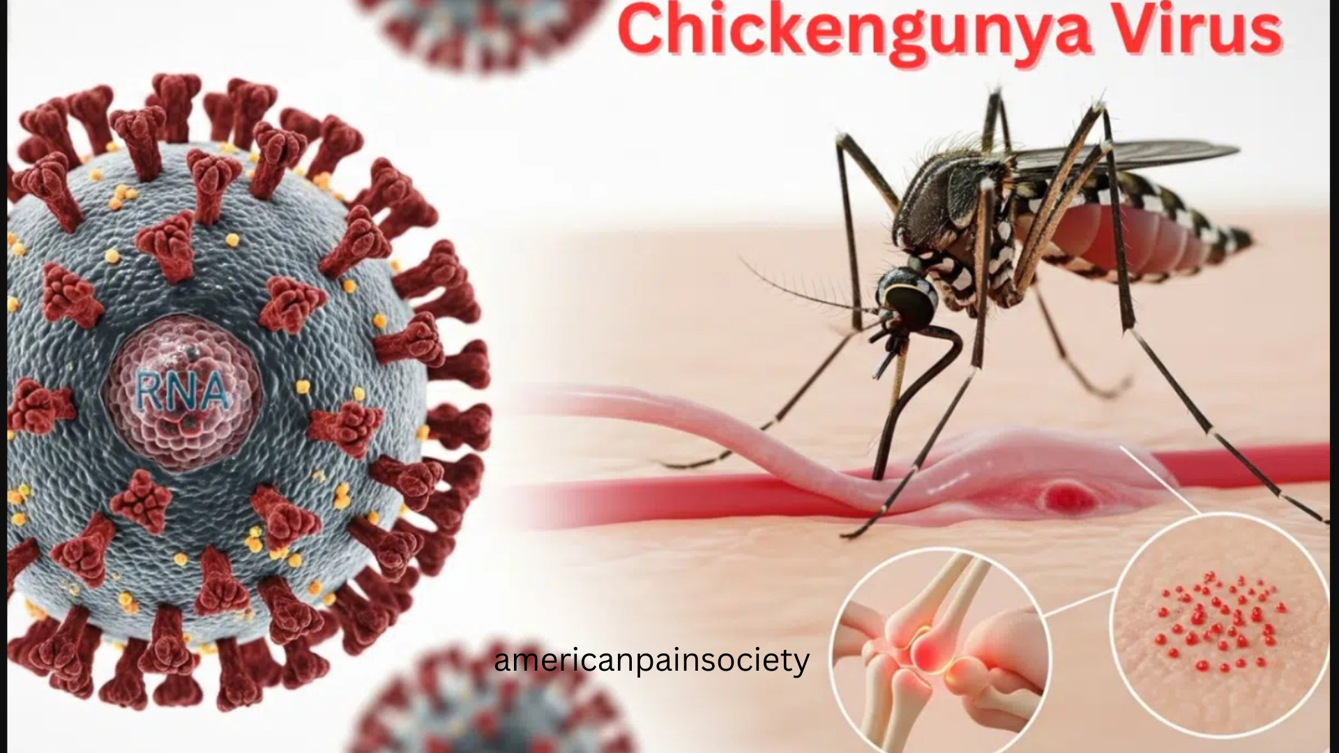 Chikungunya Virus Outbreak 2025 