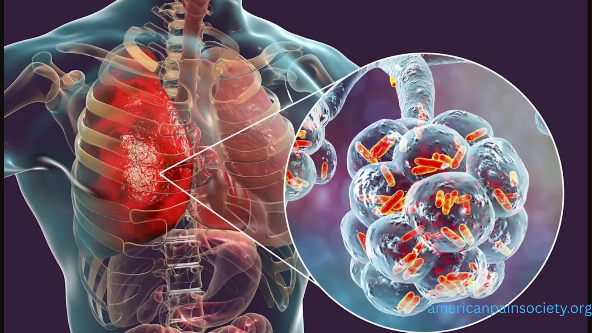 Legionnaires' Disease